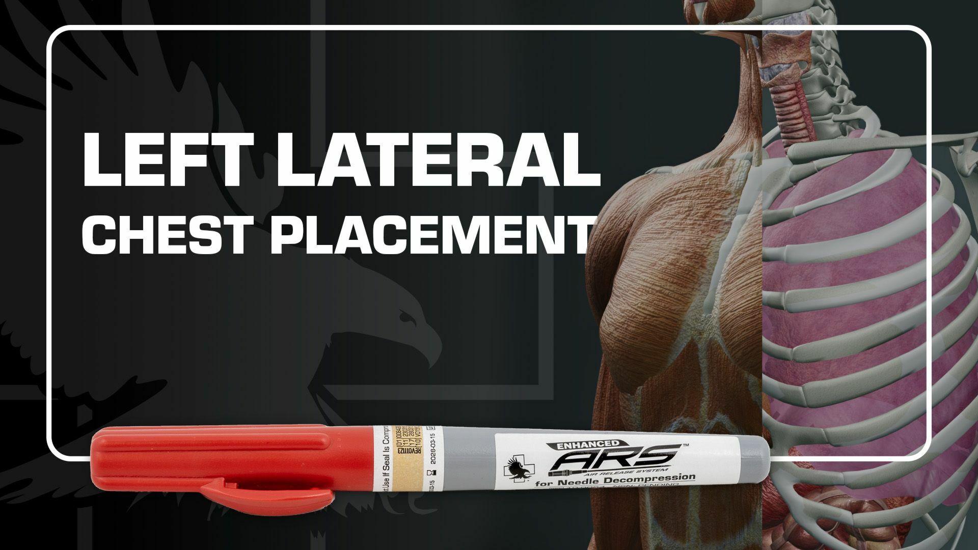 Learn About Left Lateral Chest Placement for Needle Decompression