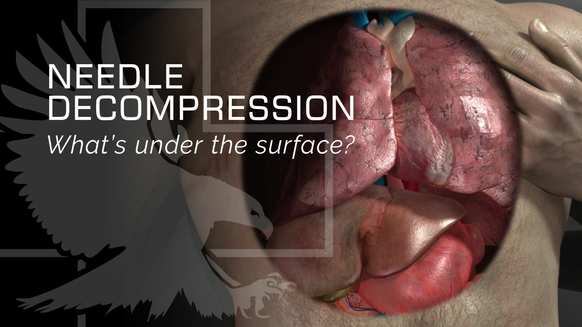 Needle Decompression: What's Under The Surface?