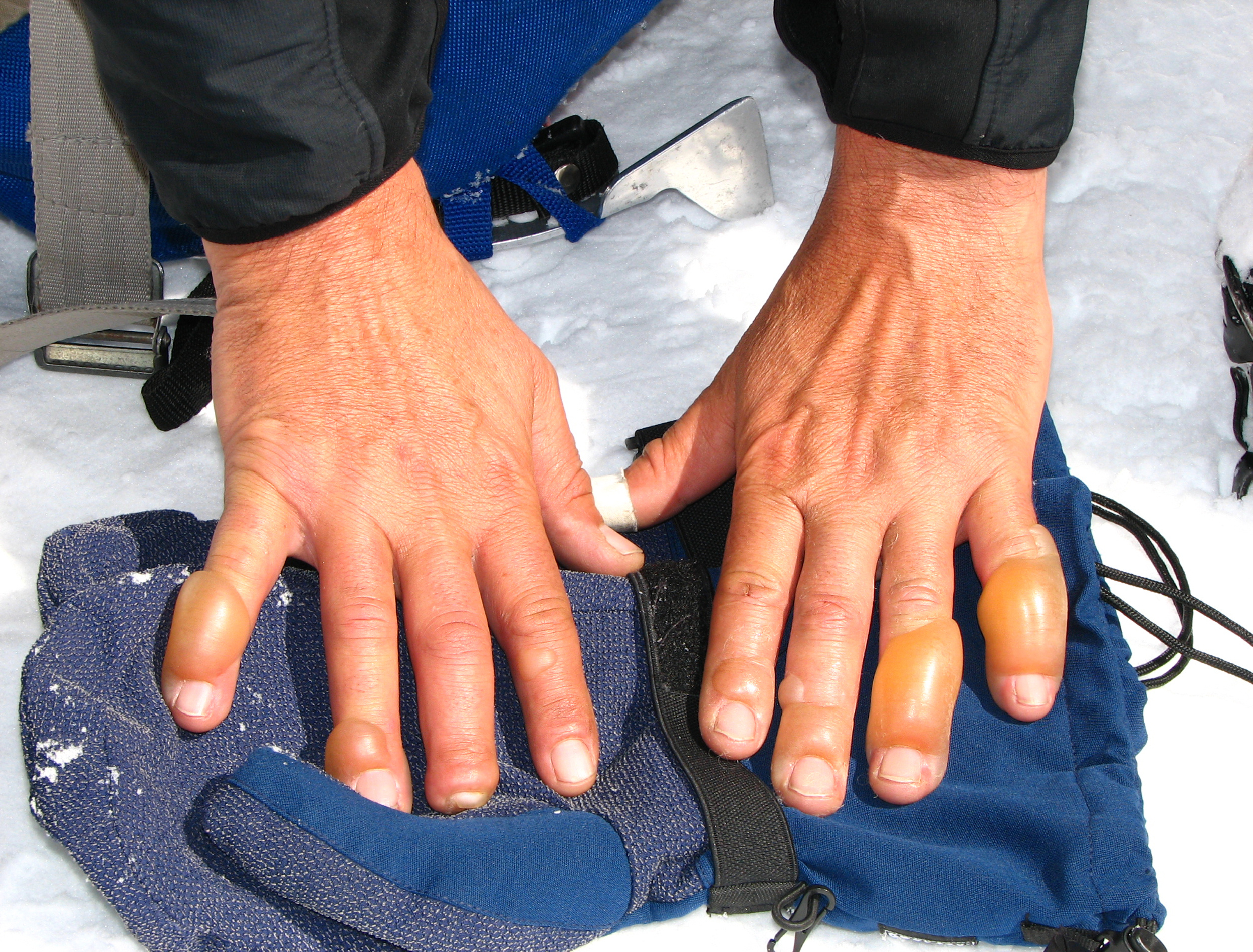 WMS Frostbite Guidelines AdobeStock 245421408 WMS Frostbite Guidelines AdobeStock 245421408