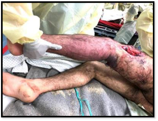 Venous_Tourniquet Venous_Tourniquet