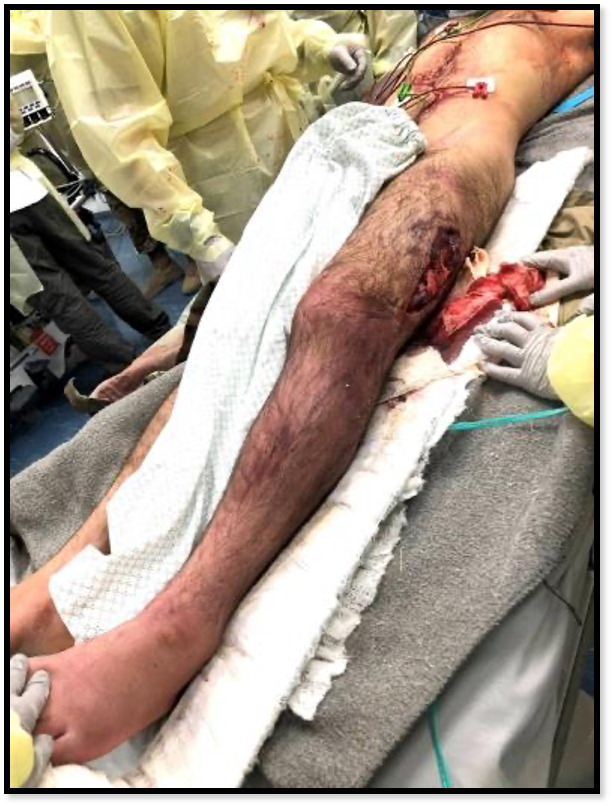 Venous_Tourniquet Venous_Tourniquet