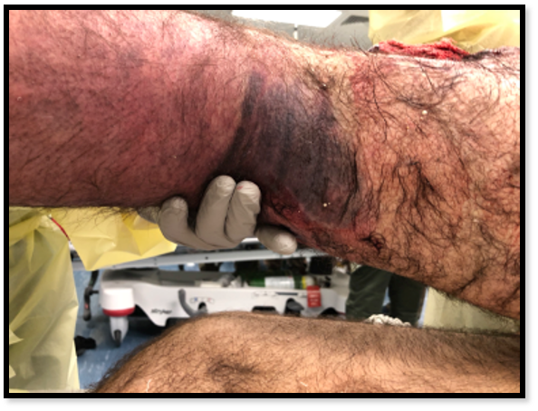 Venous_Tourniquet3 Venous_Tourniquet3