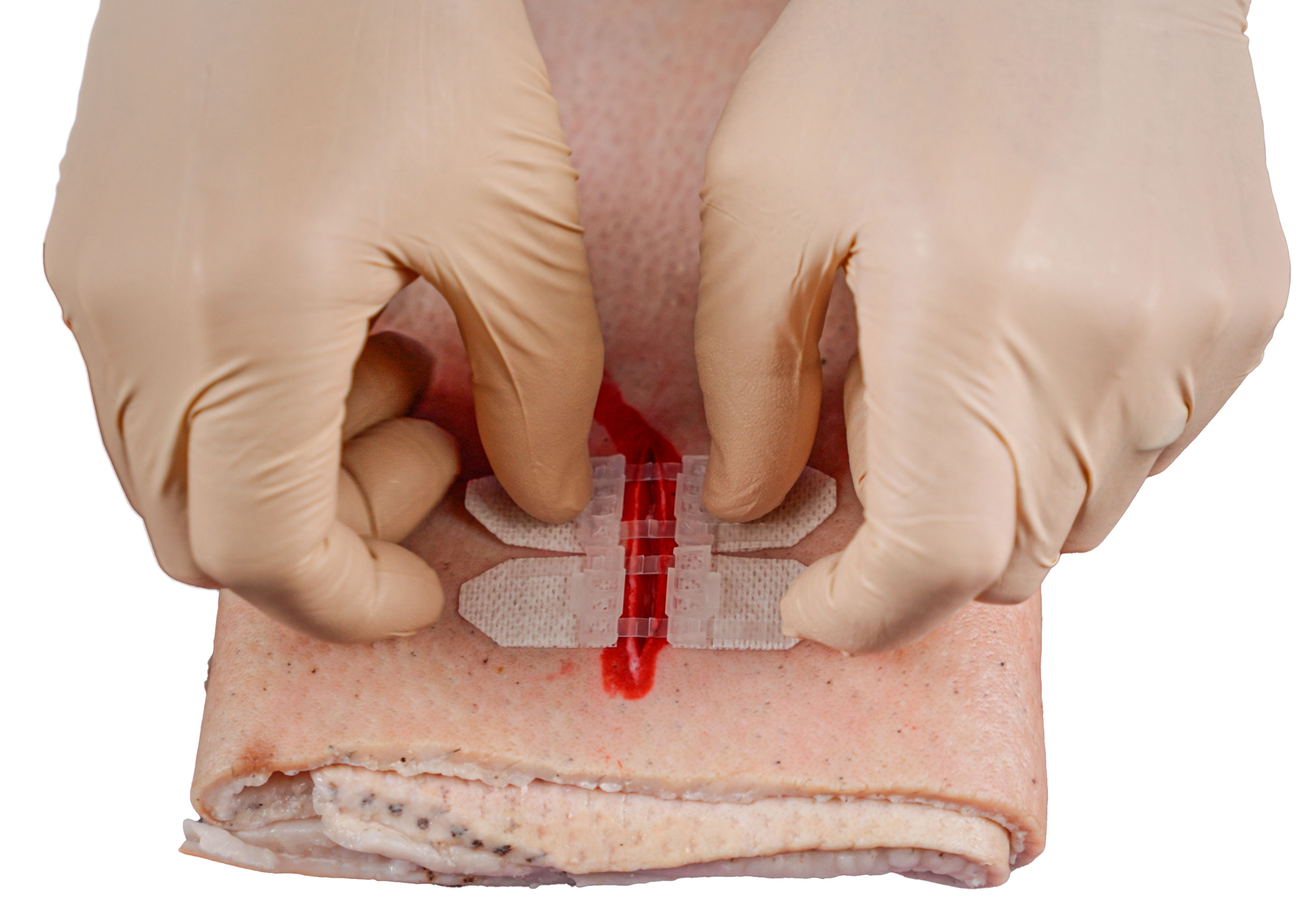 wound closure 101 - part 2 blog wound closure 101 - part 2