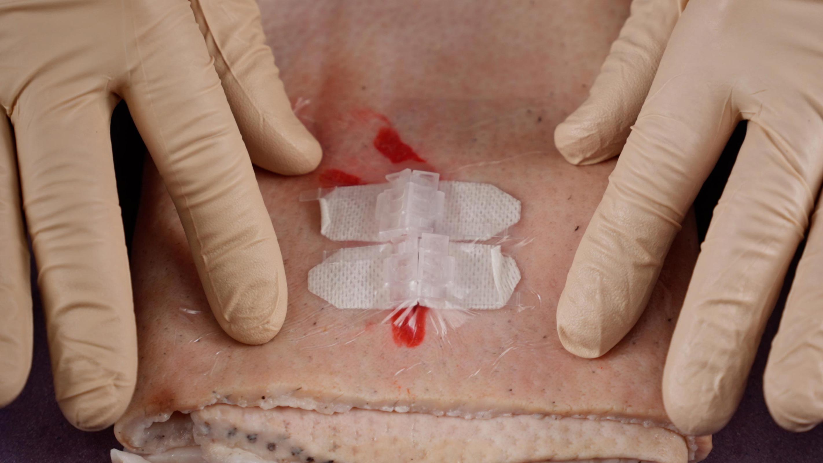 wound closure 101 - part 2 blog wound closure 101 - part 2